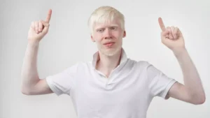 Albino hastaligi nedir 