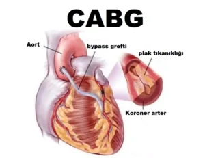 CABG NEDIR