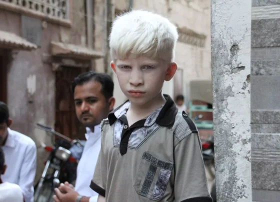 albino hastalığı nedir