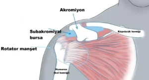 omuz sikisma sendromu