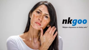 Vitiligo olmayan beyaz lekeler 