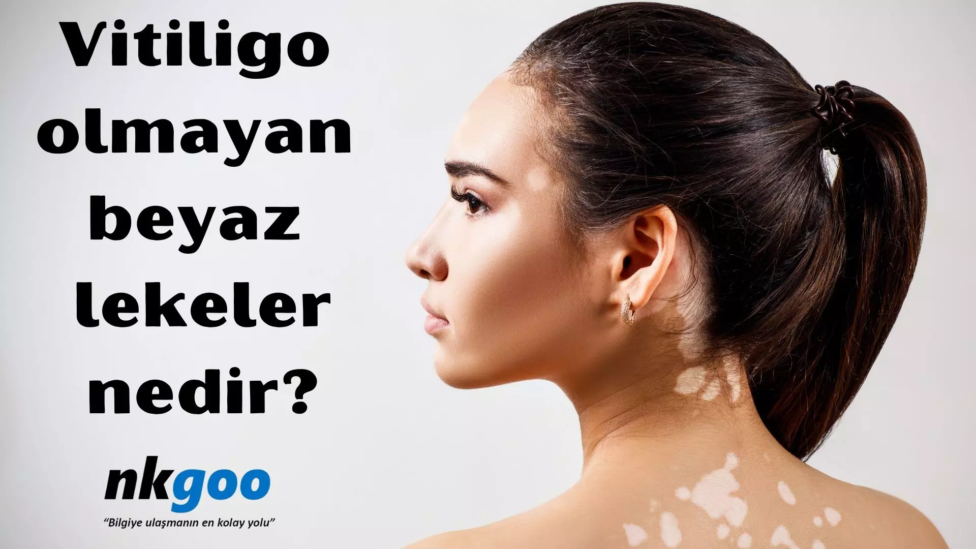 Vitiligo olmayan beyaz lekeler nedir? Sebebi