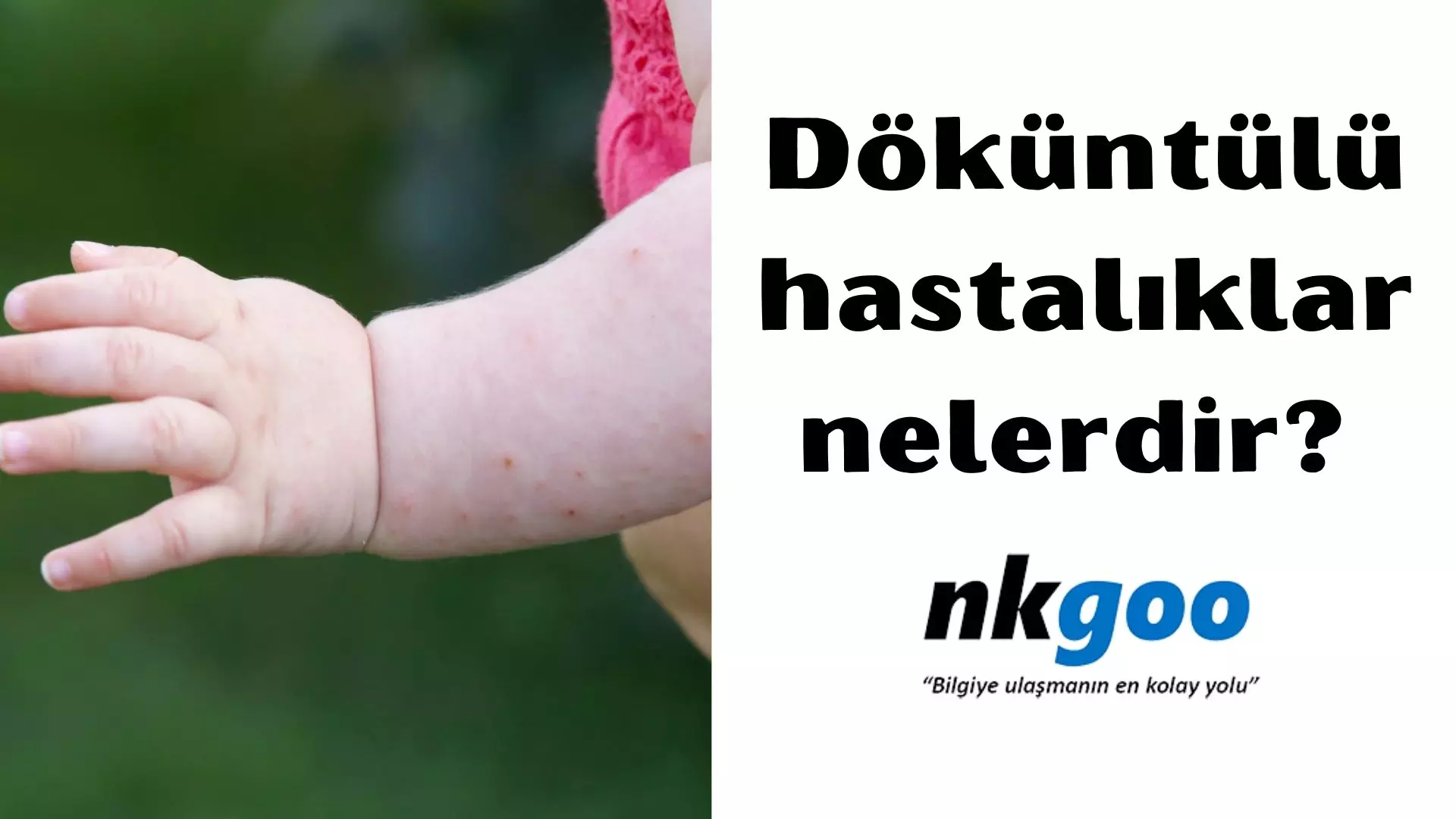 Döküntülü Hastalıklar nelerdir? 5 nedeni