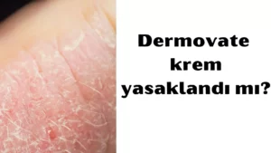 Dermovate krem yasaklandı 