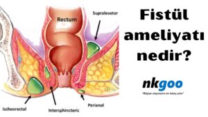 Fistül ameliyatı 
