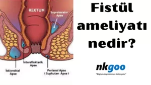 Fistül ameliyatı 